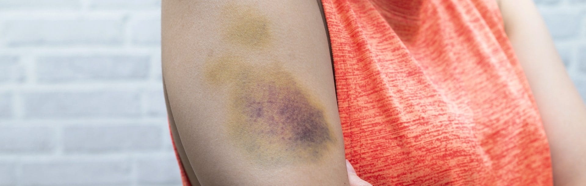 Woman with multiple bruises on her arms